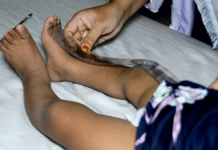 Apparent efficacy of food-based calcium supplementation in preventing rickets in Bangladesh